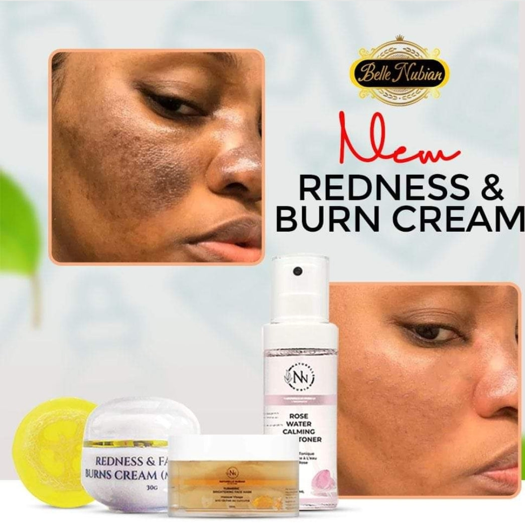 Redness and facial burns cream ( melasma)