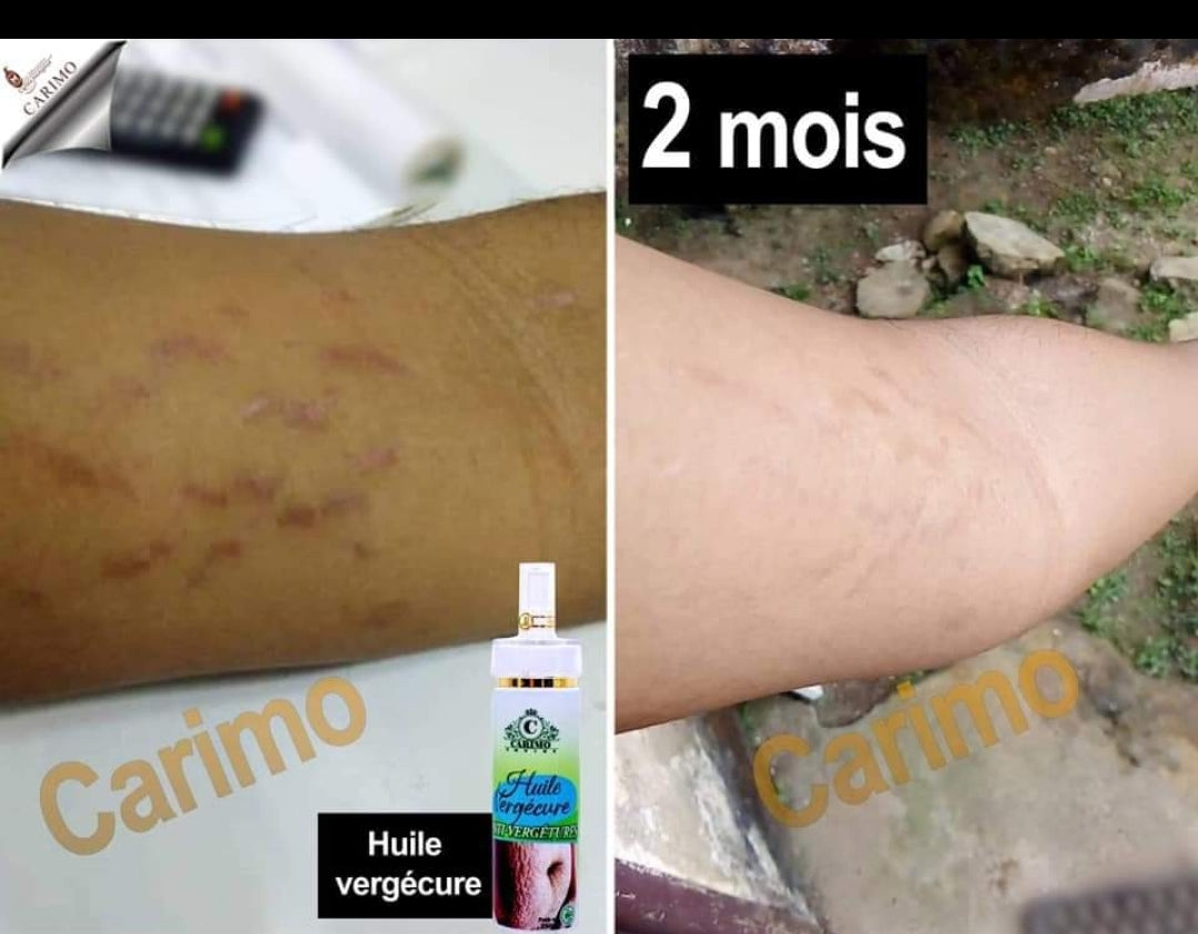 Carimo Stretch Marks Oil